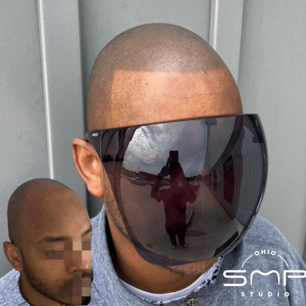 Reclaiming Confidence with Scalp Micropigmentation