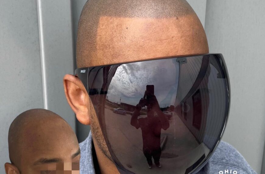 Reclaiming Confidence with Scalp Micropigmentation