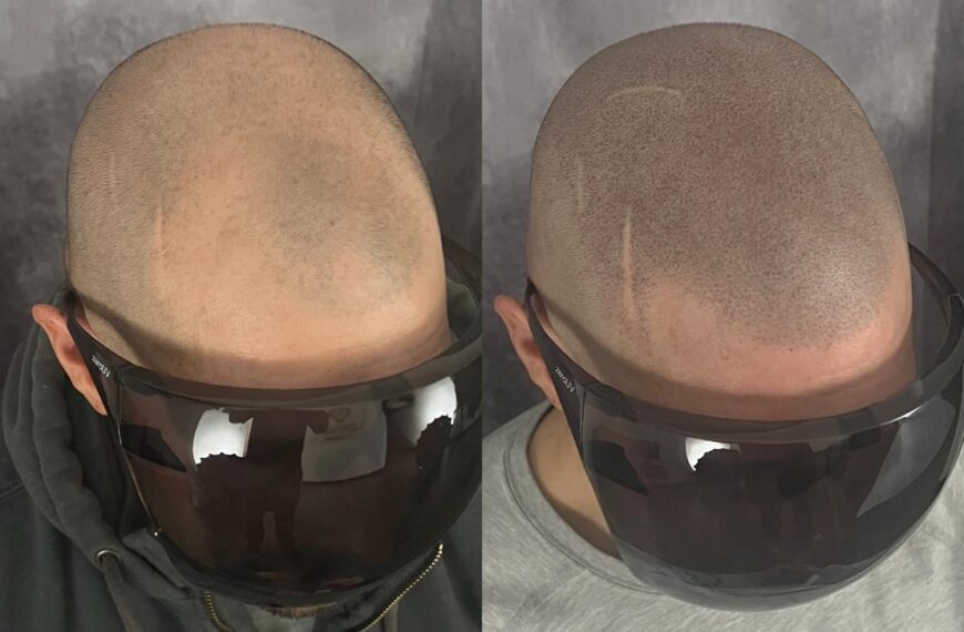 Restore Confidence with Scalp Micropigmentation
